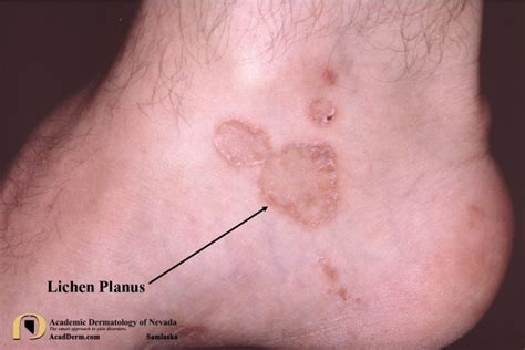 Lichen Planus Tree Moss On A Flat And Even Surface Academic