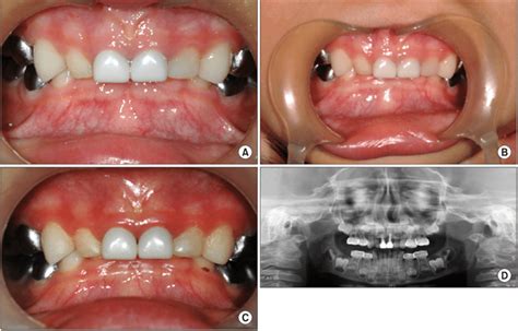 Clinical Photographs And Periapical Radiograph Of Case 1 A Findings