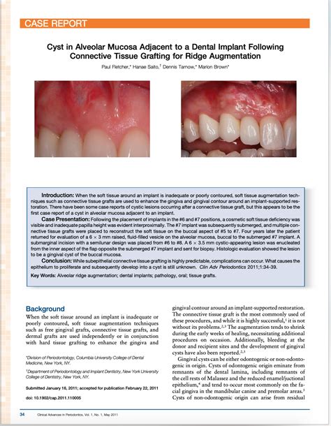 Cyst In Alveolar Mucosa Adjacent To A Dental Implant Following