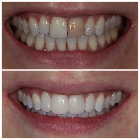 Treating Discoloured Teeth With Composite Bonding Smile Cliniq