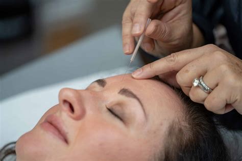 Cosmetic Acupuncture Hatfield Practice