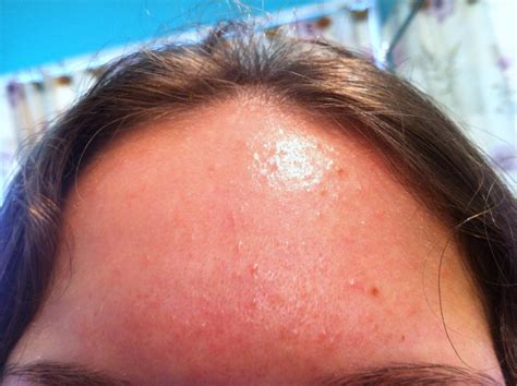 Forehead Bumps Pic Included General Acne Discussion