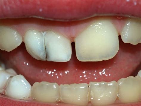 Image Result For Dental Fusion Dental Teeth Diseases Dreams About Teeth