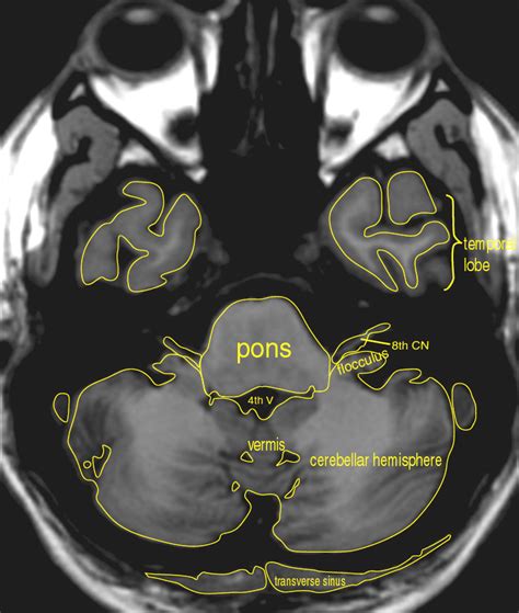 Mri Brain Flocculus Anatomy