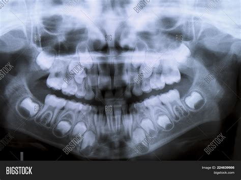 Panoramic Dental X Ray Image And Photo Free Trial Bigstock