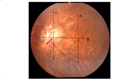 Fundus Photograph Of The Left Eye Glaucomatous Optic Neuropathy A