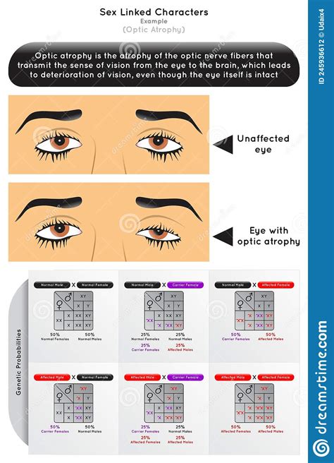 Sex Linked Characters Infographic Diagram With Example Of Optic Atrophy Stock Vector