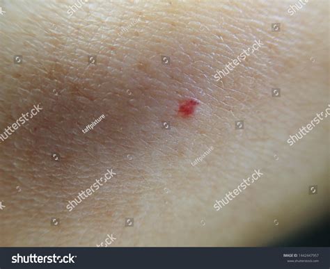 Red Spot On Skin Texture Skin Stock Photo 1442447957 Shutterstock