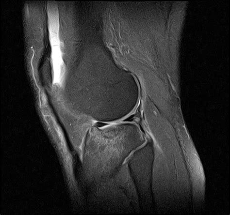 Tibial Plateau Fracture Image