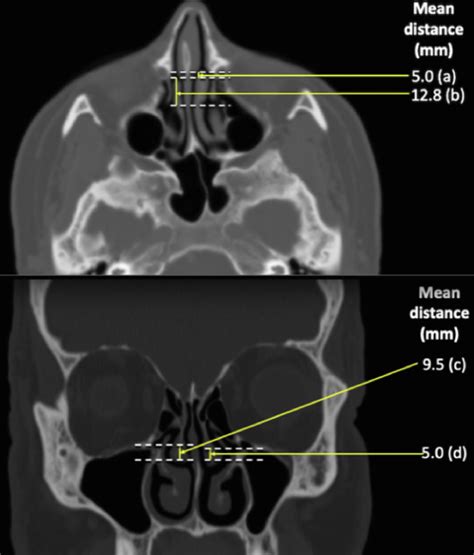 The Middle Turbinate As An Anatomical Landmark For A Safe Maxillary