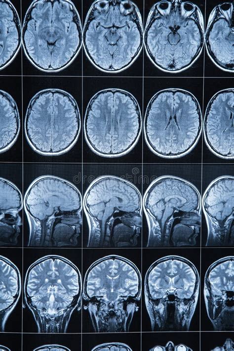 Magnetic Resonance Imaging Of The Head And Brain Mri Stock Image