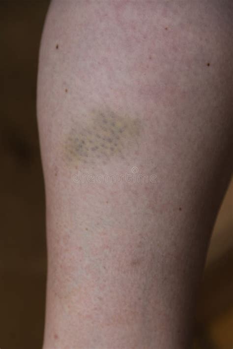 Bruise On The Lower Leg Hematoma Stock Image Image Of Bruise
