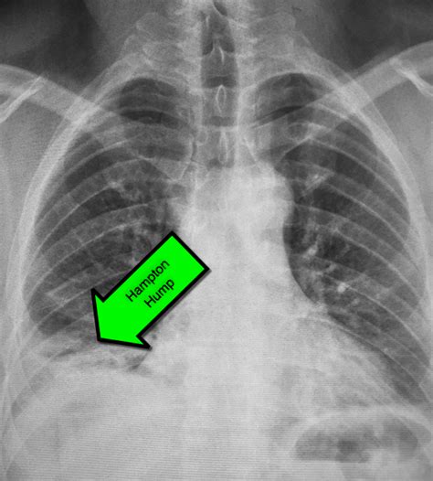 How To Detect A Pulmonary Embolus On X Ray Emergency Medicine Kenya