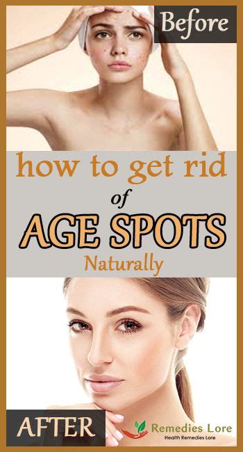 How To Get Rid Of Age Spots Naturally And Instant With Images Age