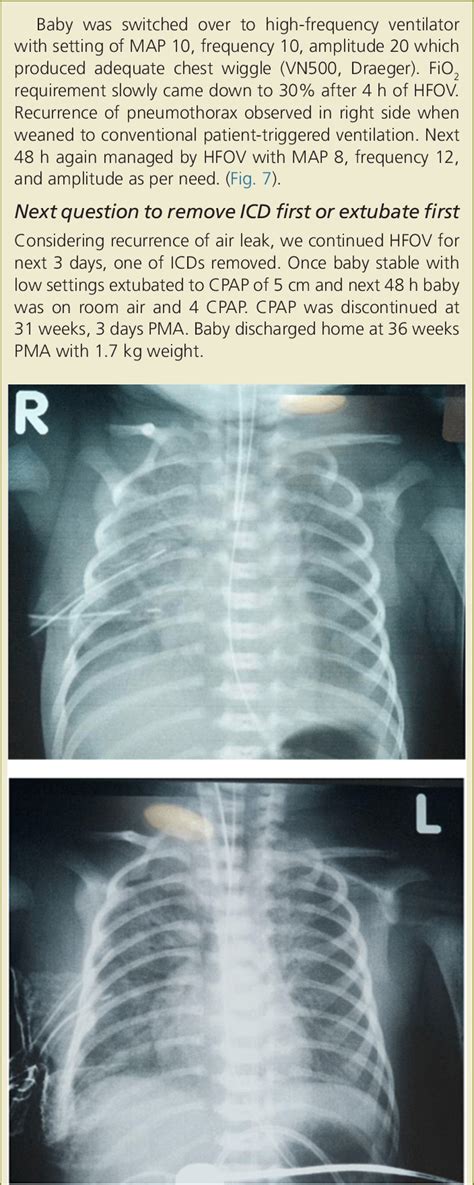Resolution Of Right Sided Pneumothorax After 2nd Icd Download