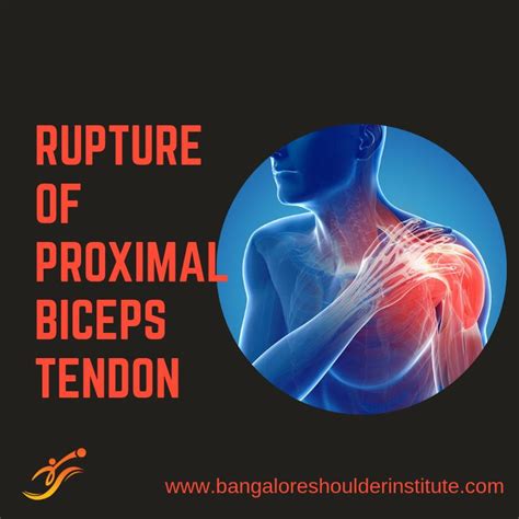 Biceps Tendon Rupture Bicep Tendonitis Tendon Tear Rotator Cuff Tear