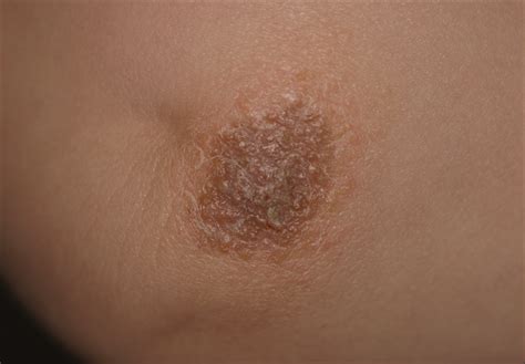 Picture Of The Month—quiz Case Dermatology Jama Pediatrics Jama