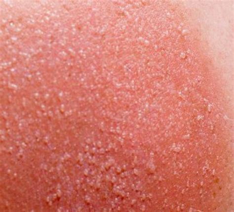 How To Treat Heat Rash And What Are The Symptoms Metro News