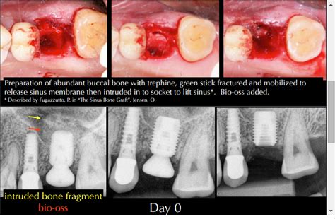 Immediate Implant Placement With Internal Sinus Lift Using Socket Intrusion
