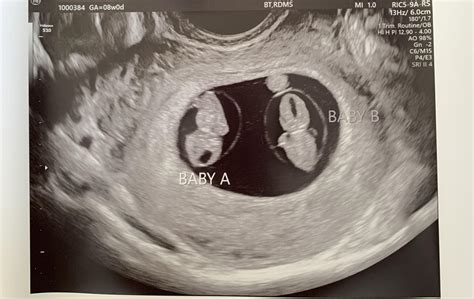 Hello New To This Group And A Ftm At Our First Ultrasound 8w