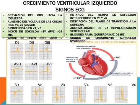 Hipertrofia Ventricular Electrocardiograma