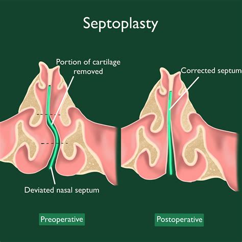Endoscopic Septoplasty Dr Preethi Umamaheswaran Ms Dnb Ent