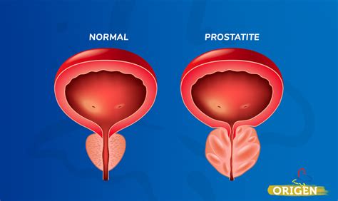 Prostatite E Reprodução Assistida