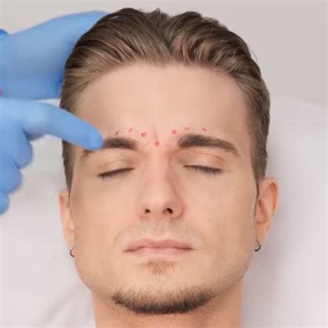 Botox Injection Patterns For Men Dr Tim Pearce