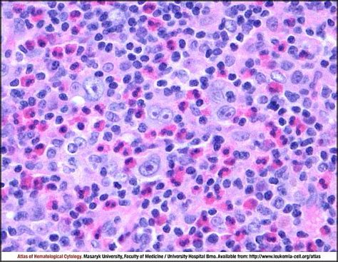 Mixed Cellularity Classic Hodgkin Lymphoma Cell Atlas Of