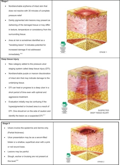 Chart Pressure Ulcer Staging Guide