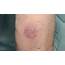 Skin Cancer & Pre Cancerous Lesions  Laser