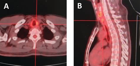 Petct Imaging In Fever Of Unknown Origin A Case Of