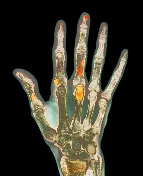 Bone Cancer In Hand X Ray Photograph By