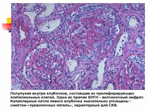 Диета при системная красная волчанка Системная красная волчанка Системная красная волчанка Диета при системная красная волчанка
