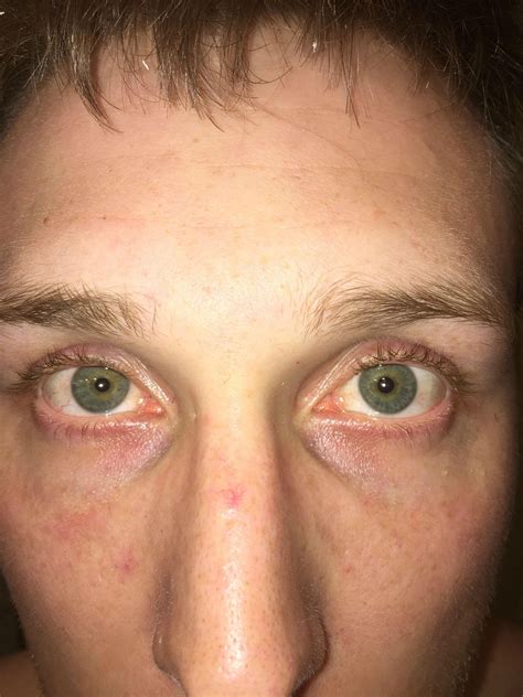 Skin Concerns Bad Dark Circles Under Eye Dont Seem To Respond To