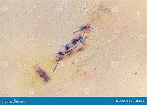 Stitched Wound After Skin Biopsy On Mens Back Stock Images Image