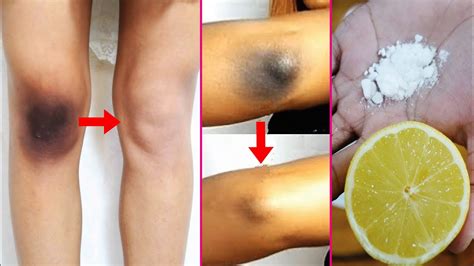 How To Lighten Dark Knees And Elbows Naturally At Home Dark Knees And Elbows Whitening Home