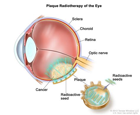 The retina is a thin layer of nerve tissue that coats the back of the eye and enables the eye to see. Retinoblastoma Treatment (PDQ®)—Patient Version - National ...