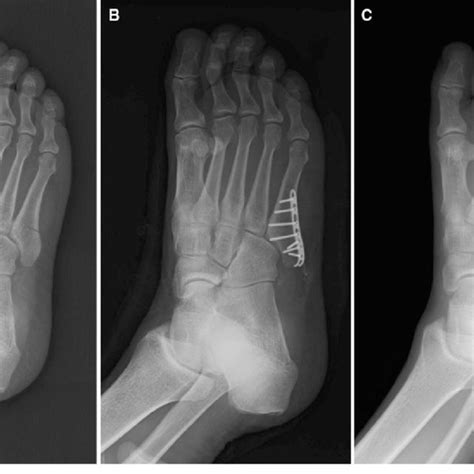 A 64 Year Old Woman With A Fifth Metatarsal Base Fracture A Download Scientific Diagram