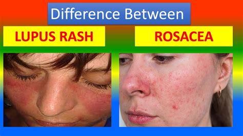 Difference Between A Lupus Rash And Rosacea Youtube