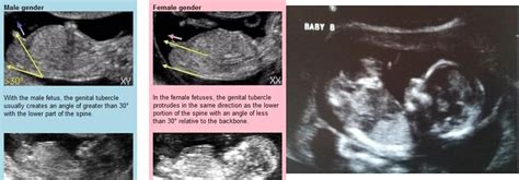Infografik waktu sesuai untuk baby scan & soalan kegemaran (faq) berkenaan scan sepanjang tempoh mengandung. Gender predictions?? - April 2017 - BabyCenter Canada