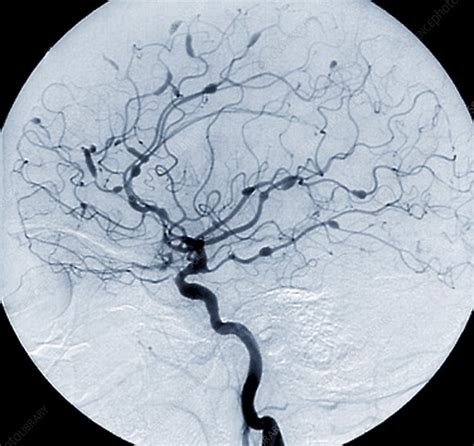 Cerebral Aneurysms In Lupus Angiogram Stock Image C0041393