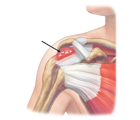 Disease By Calcium Deposition Of Various Sizes On The Tendons Of The Rotator Cuff