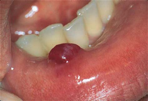 A Short Note On Mucocele Oral Surgey ~ Dentistry And Medicine