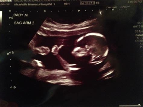 Funny Ultrasound Photo Shows Shows Baby Giving A Thumbs Up