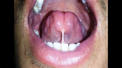 Tongue Tie Surgery Lingual Frenectomy Dr Amit Mohan Youtube