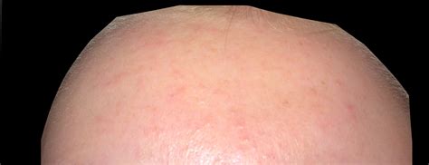 Tiny Bumps And Redness General Acne Discussion By Superanonymous