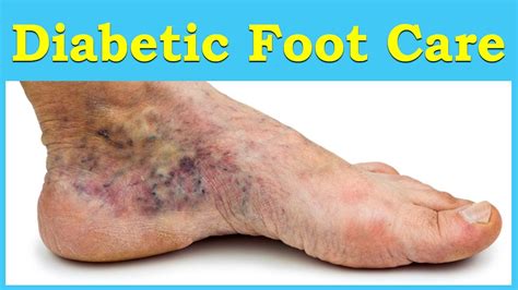 Diabetic Foot Problems Symptoms And Treatment For Diabetic Feet Youtube