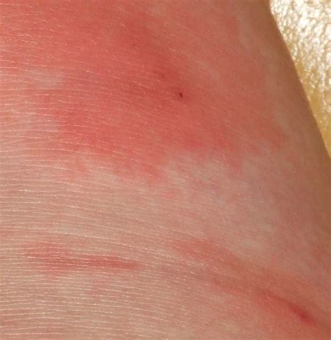 Causes And Symptoms Of Skin Rashes Fungal Infection Hot Sex Picture