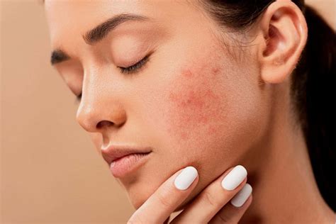 How To Treat Hormonal Acne Tips From Dermatologists Hooshout